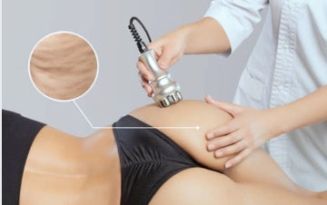 Cellulite Treatment